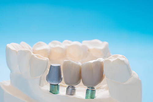 Dental Implants