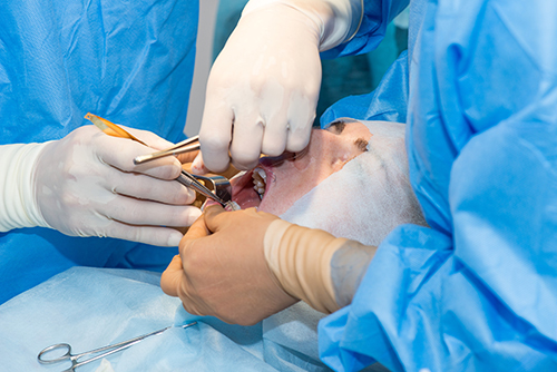 Oral Surgery and Wisdom Teeth Removal